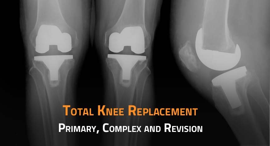 Total Knee Replacement